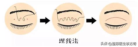 埋线法双眼皮手术 双眼皮有几种术式？ 说明书网