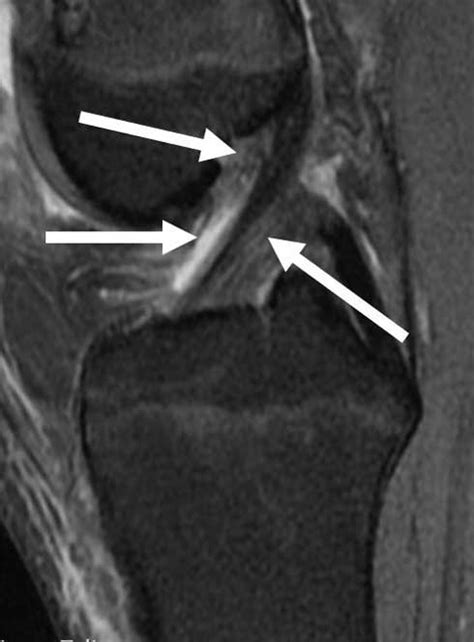 Mri Knee Acl Tear