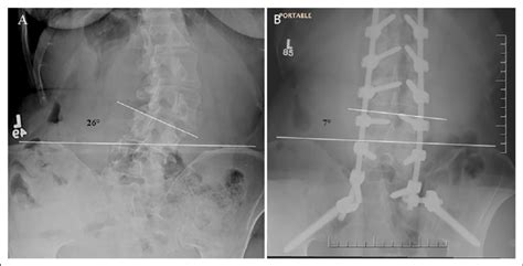 Preoperative Standing Anteroposterior Radiograph A Demonstrating An