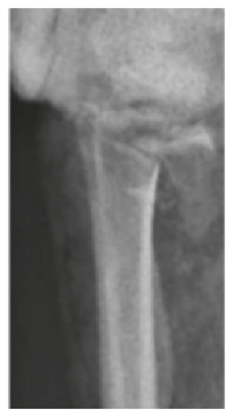 Preoperative X Rays Anteroposterior And Lateral View Of The 23c2 Download Scientific Diagram