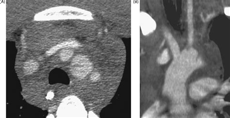 Diagnosis Of Blunt Traumatic Aortic Injury Still A Nemesis