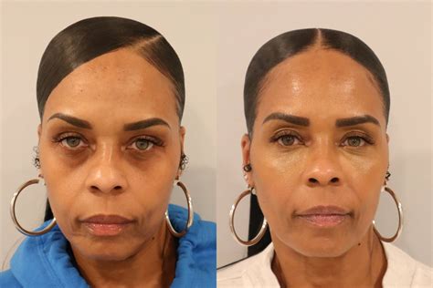 Before And After Image Gallery Cosmetic Skin Institute Skin Care In