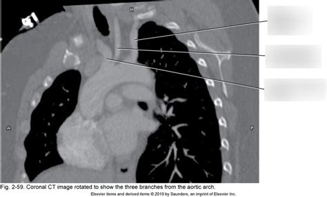 CT Coronal Image Branches Of Aortic Arch Diagram Quizlet