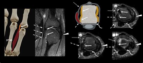 Stener Like Lesions In The Hand Knee And Foot A Review Of Anatomy