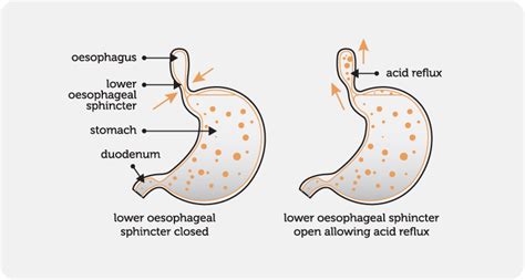 Gastro Oesophageal Reflux Bronchiectasis