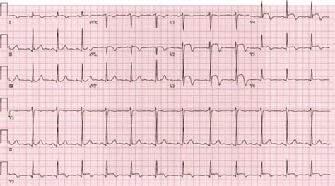 Electrocardiogram Shows St Elevations In The Anterior And Lateral Leads