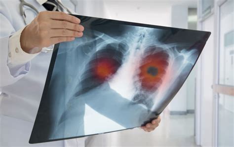 Stage 1 Lung Cancer Symptoms: What You Should Know