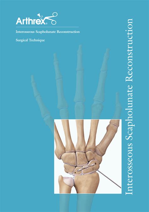 Interosseous Scapholunate Reconstruction