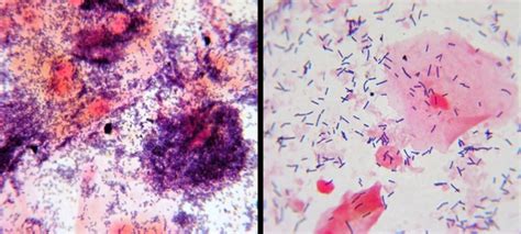 Fun With Microbiology Whats Buggin You Bacterial Vaginosis