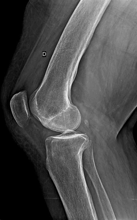 Osteochondritis Dissecans Of The Knee Image