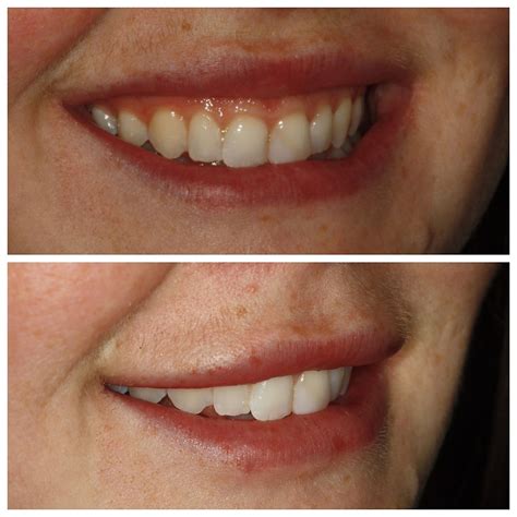 Gummy Smile Correction Navigating Your Path With Estetica