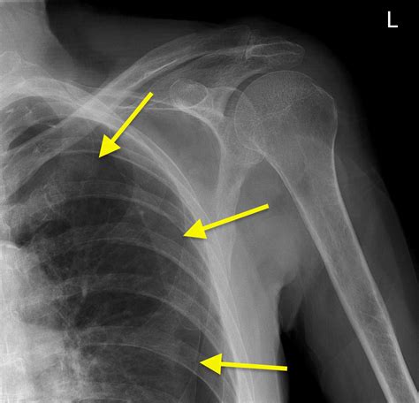 Pneumothorax on shoulder X-ray - Radiology at St. Vincent's University ...