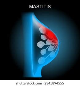 Mastitis Crosssection Mammary Gland Inflammation Breast Stock