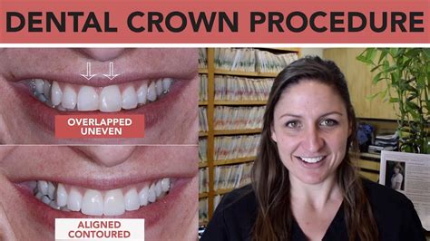 Why Are Dental Crowns Needed At David Russo Blog