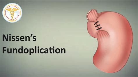 Recovery After Laparoscopic Nissens Fundoplication What To Expect