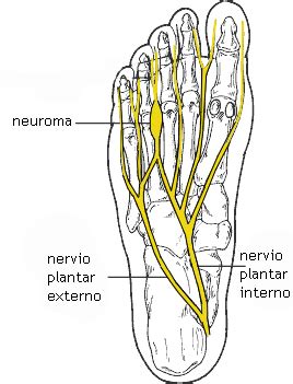 neuroma de morton Clínica de Fisioterapia en Almería