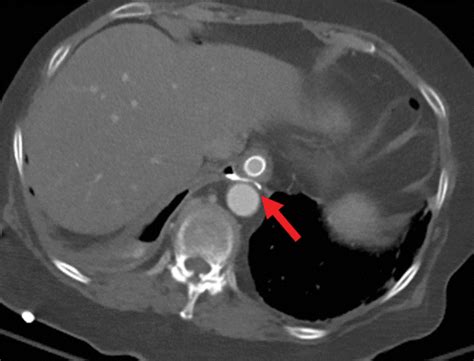 CT Esophagography For Evaluation Of Esophageal Perforation RadioGraphics