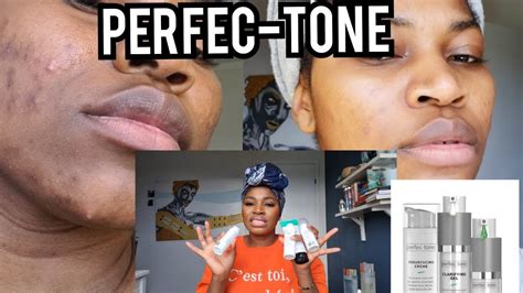 How To Cure Acne Fast With Perfec Tone Acneremedy Hyperpigmentation