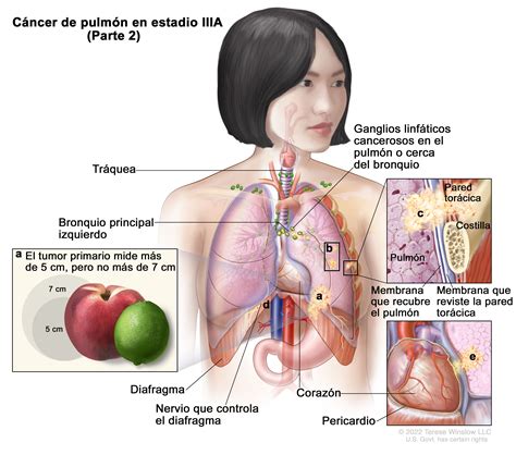 Tratamiento del cáncer de pulmón de células no pequeñas NCI