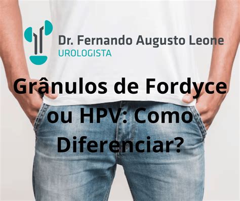 Gr Nulos De Fordyce Ou Hpv Como Diferenciar Dr Fernando Leone