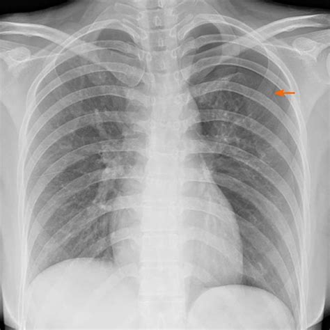 X Ray Showing Pneumothorax Patient S Chest X Ray Showing Pneumothorax