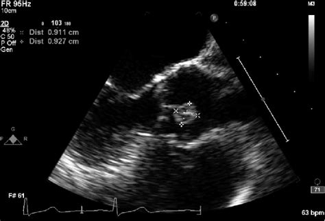 Mid Esophageal Aortic Valve Long Axis View Showing The Papillary