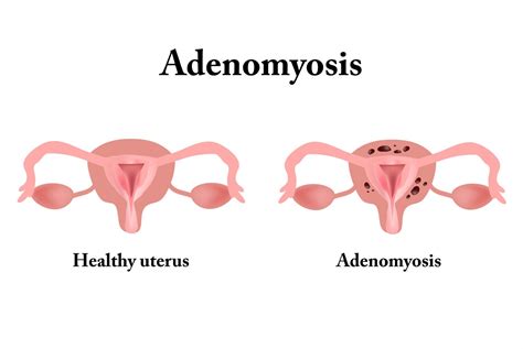 What Is Adenomyosis And How Is It Treated New York City 1 Fibroid