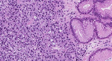 Adenocarcinoma of the stomach | Atlas of Pathology