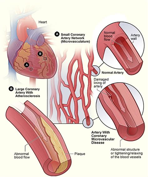 Signs And Symptoms Of A Heart Attack What You Should Do To Save Life