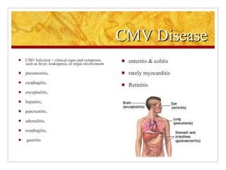 CMV in Organ Transplantation | PPT