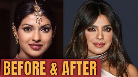 Priyanka Chopra Plastic Cosmetic Surgery 2020 YouTube