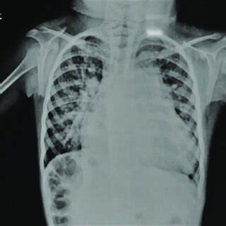 X Ray Chest PA Shows Massive Cardiomegaly With Enlarged Main And