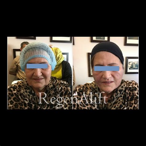 Regenalift The Regenerative Facelift Pdo Thread Lift Pdo