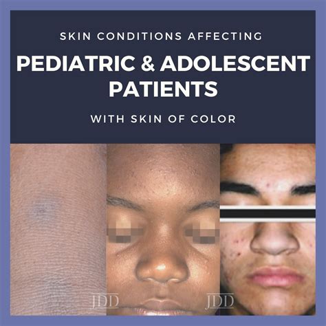 Skin Conditions In Pediatric And Adolescent Patients With Skin Of Color