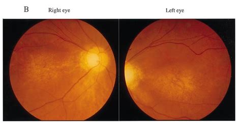 A Colour Fundus Photography Of Right And Left Eyes Of A Year Old