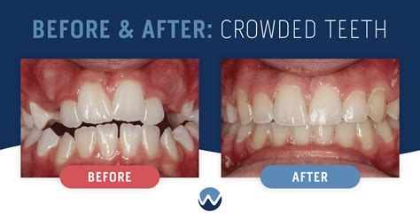 Crowded Bottom Teeth Before And After