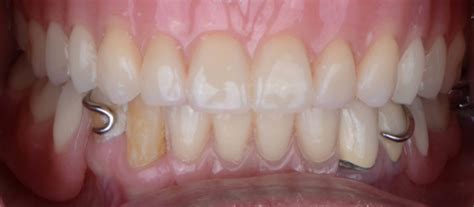 Dentures Before And After Rockville Dental Arts