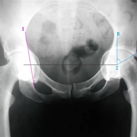 Acetabular Protrusion Cause Symptoms Treatment