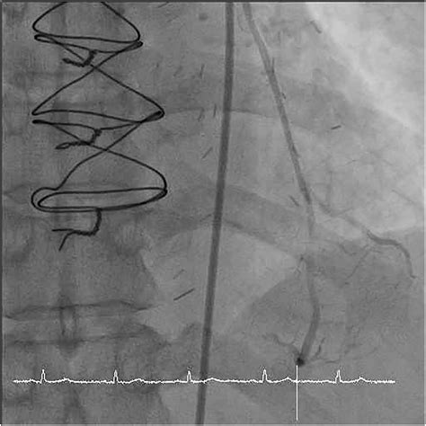 Tctap C A Challenging Case Report Kawasaki Disease With Graft