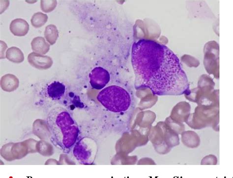 Figure 2 From Hemophagocytic Syndrome And Inflammatory Myopathy With