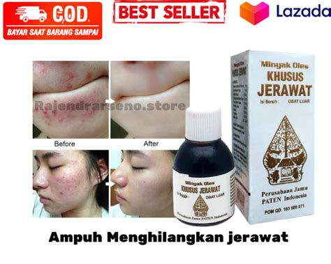 Original Minyak Oles Khusus Jerawat Cap Wayang 35ml Bpom Obat Jerawat Cap Wayang Penghilang