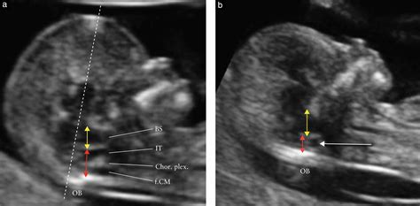 Spina Bifida Ultrasound 12 Weeks