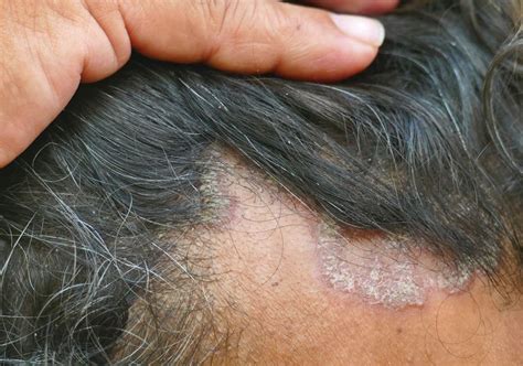 Seborrheic Dermatitis Vs Psoriasis Of The Scalp