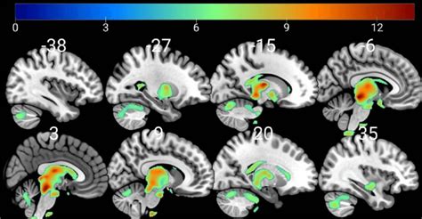 Sagittal Sections Showing Regions Of Increased Gray Matter Volume In