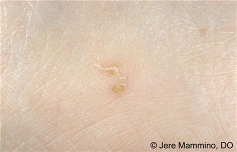 Scabies American Osteopathic College Of Dermatology Aocd 43 Off