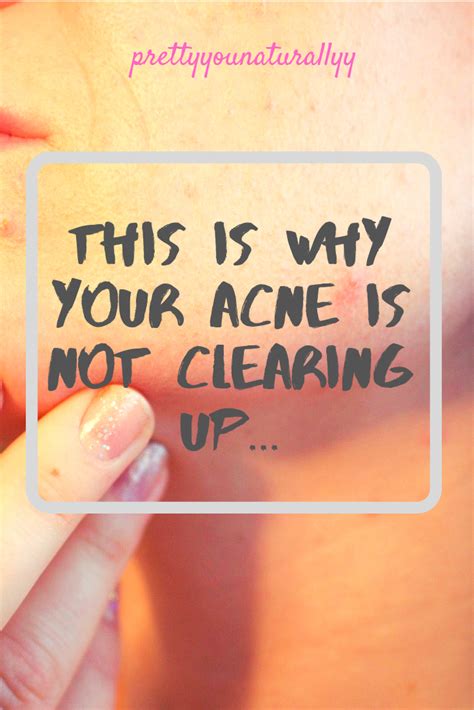 Causes Of Body Acne And How To Treat It Artofit