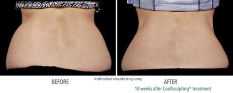 Coolsculpting Elite Fat Reduction Phoenix Az Suddenly Slimmer