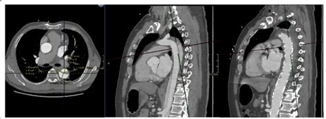 Mpr At The Level Of The Carina With Selected Fluoroscopic Images