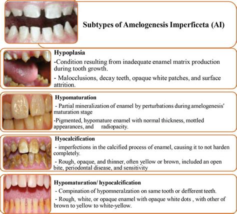 Hereditary Tooth Anomalies Amelogenesis Imperfecta Dentinogenesis