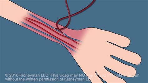 Dialysis Fistula Animation Youtube